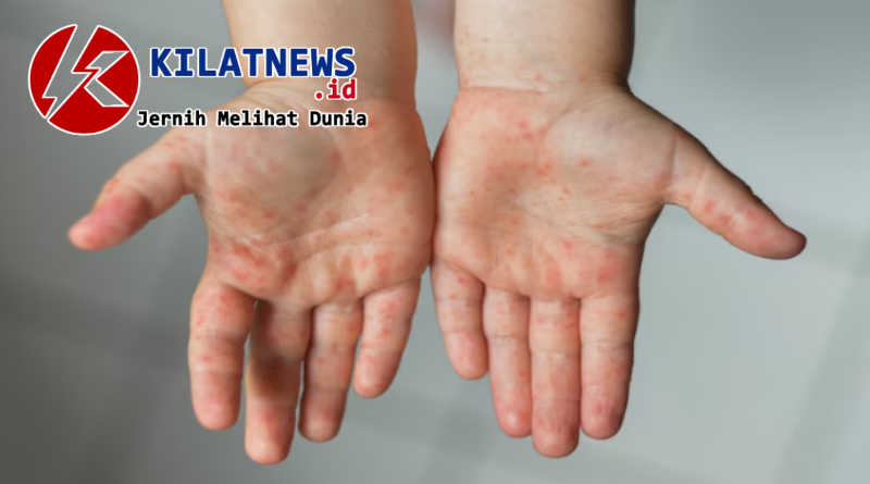 Petugas kesehatan memberikan imunisasi campak kepada anak saat penanganan KLB campak di Sulawesi Selatan