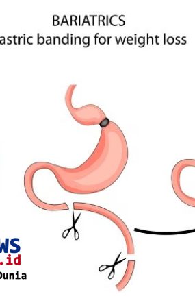 Pendampingan psikolog operasi bariatrik untuk pasien obesitas