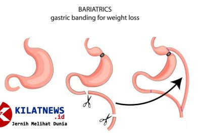 Pendampingan psikolog operasi bariatrik untuk pasien obesitas